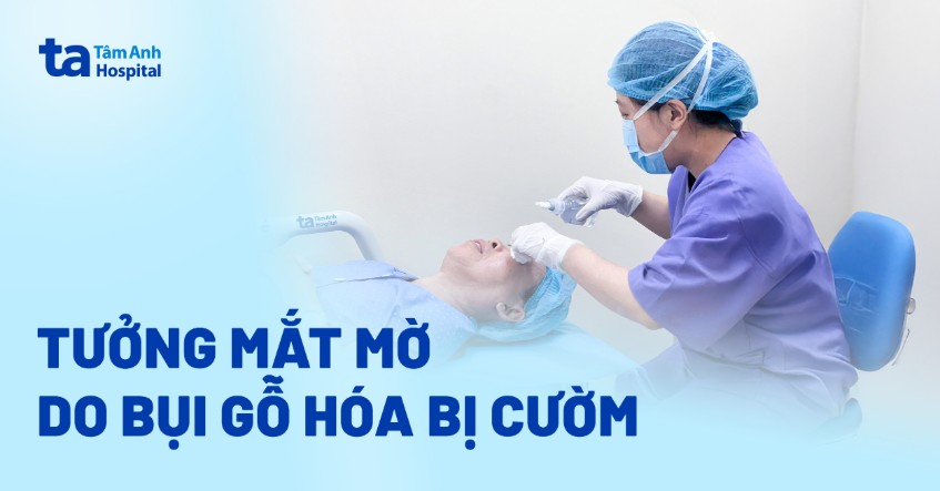 Tưởng mắt mờ do bụi gỗ hóa bị cườm