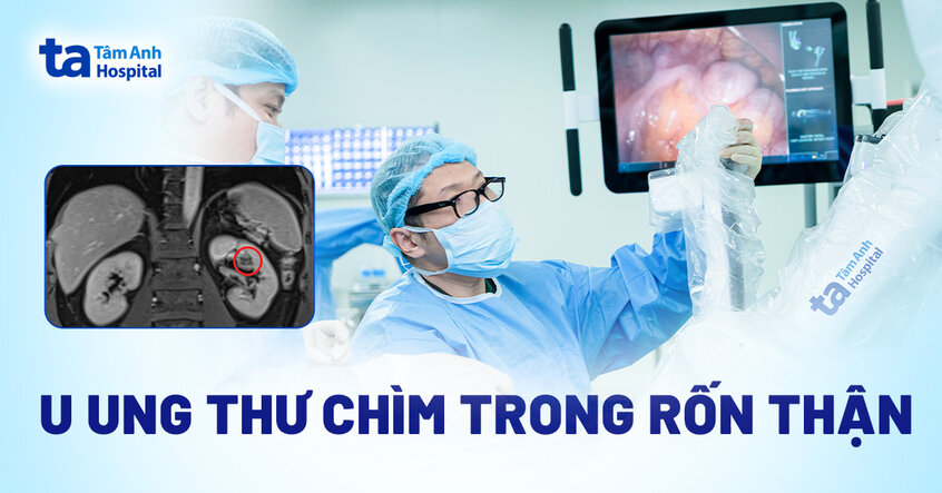 U ung thư chìm trong rốn thận