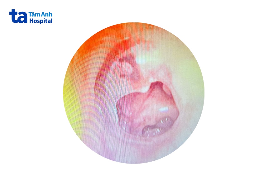 vết thủng màng nhĩ