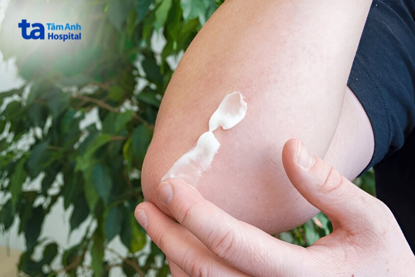 viêm da cơ địa dùng thuốc gì