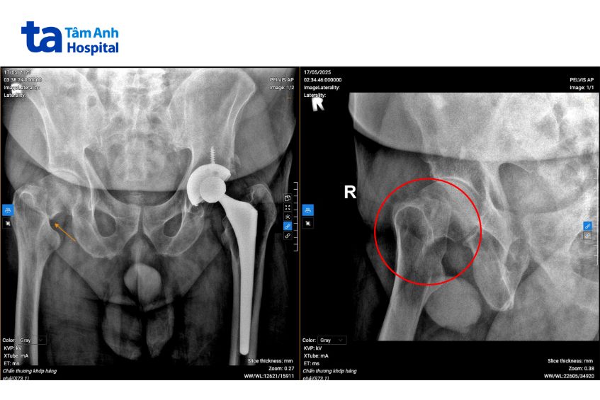 x quang gãy cổ xương đùi phải bệnh nhân