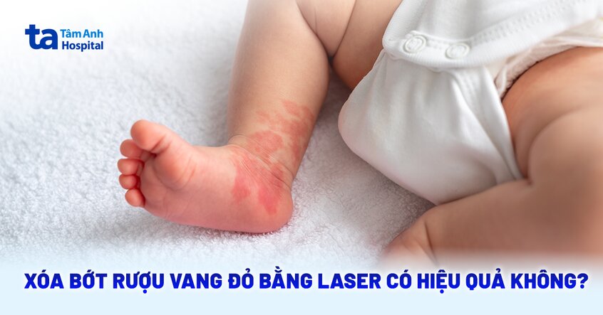 Xóa bớt rượu vang đỏ bằng laser: Quy trình, ưu nhược điểm