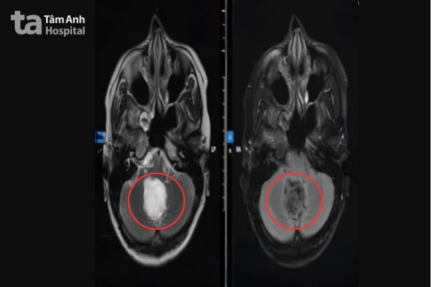 Ảnh chụp MRI khối u thân não của chị Trang.
