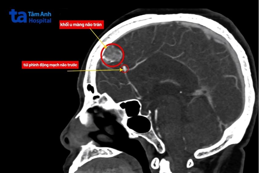 Ảnh chụp MRI khối u và túi phình mạch não của bà Hiền.