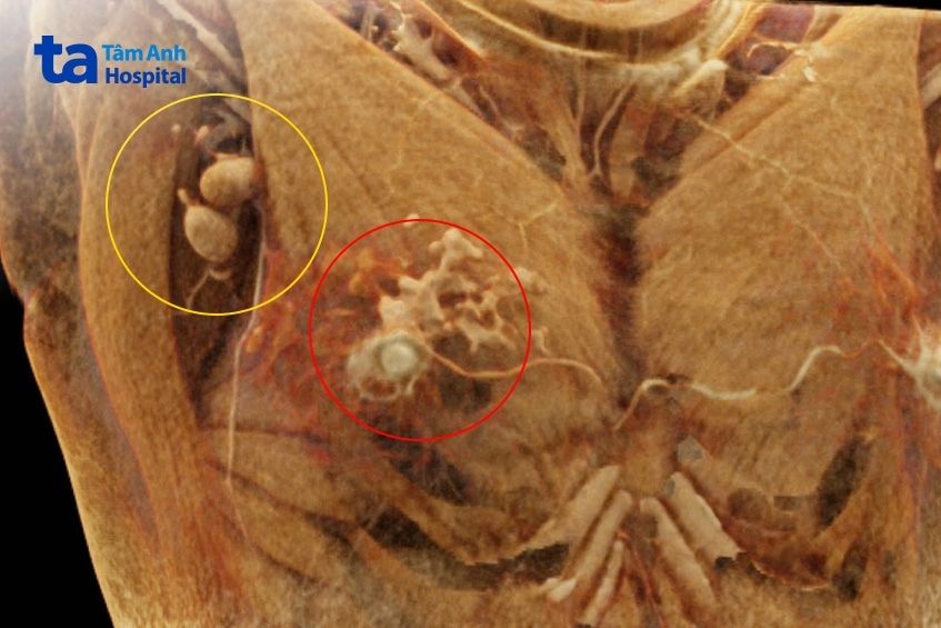 Hạch nách sát vú (vòng tròn vàng), khối u ở vú (vòng tròn đỏ) được phát hiện trên ảnh chụp của máy CT Somatom Force VB30.