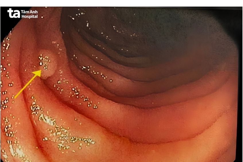 Polyp đại tràng có thể tiến triển thành ung thư nếu không được loại bỏ.