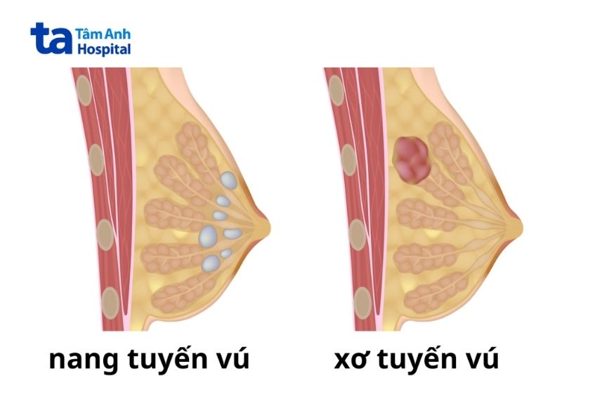 U xơ và u nang là hai loại khối u lành tính phổ biến.