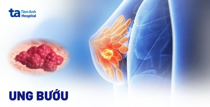 Ung bướu là gì? Nguyên nhân và cách phân biệt lành – ác tính
