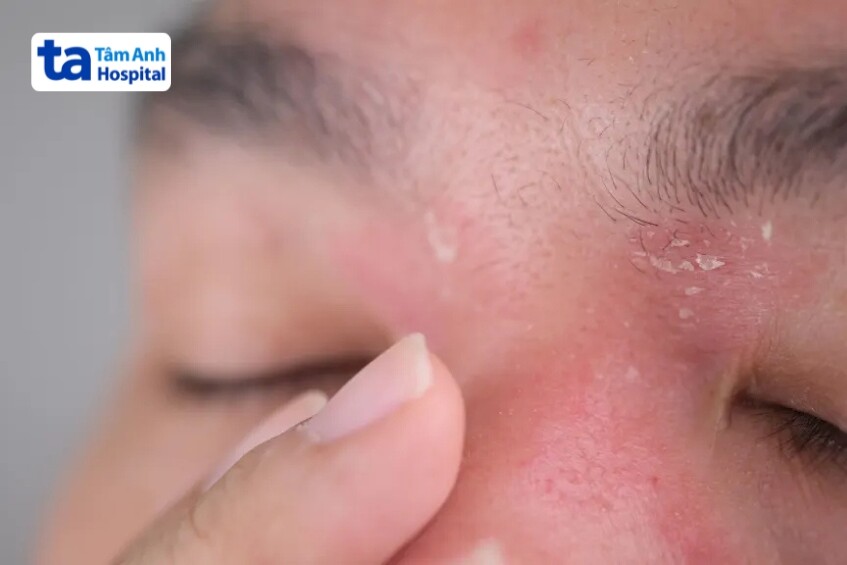 ai không nên peel da trị mụn