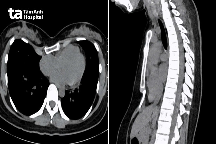 Ảnh chụp cắt lớp vi tính cho thấy ngực lõm nặng