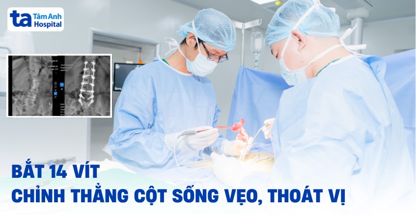 Bắt 14 vít chỉnh thẳng cột sống vẹo, thoát vị