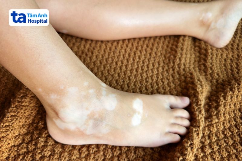 bệnh bạch biến ở mu bàn chân do sắc tố da