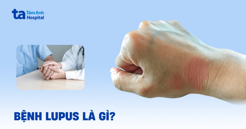 Bệnh Lupus và tất tần tật thông tin mà bạn cần biết