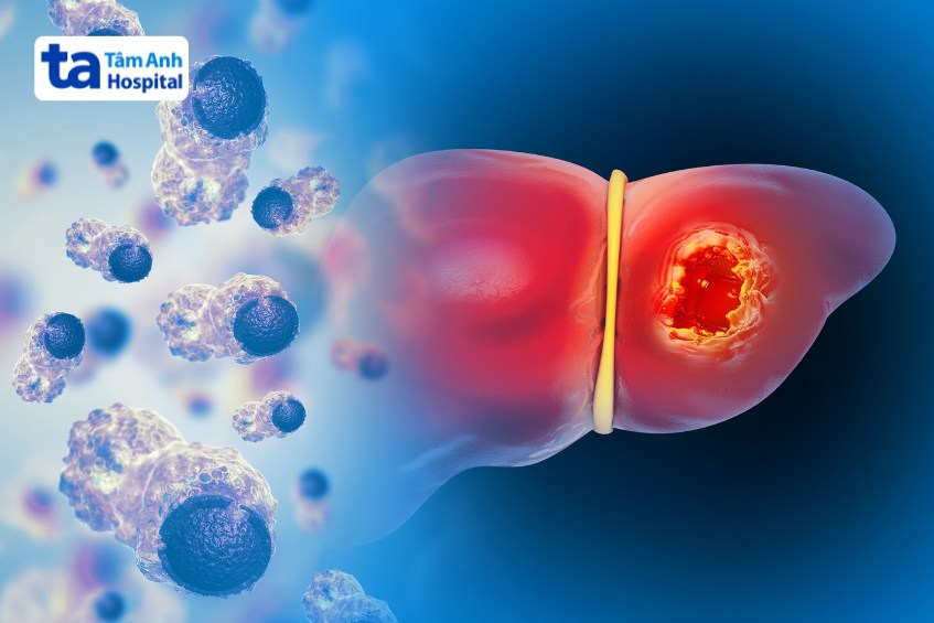 biến chứng gan nhiễm mỡ trung bình