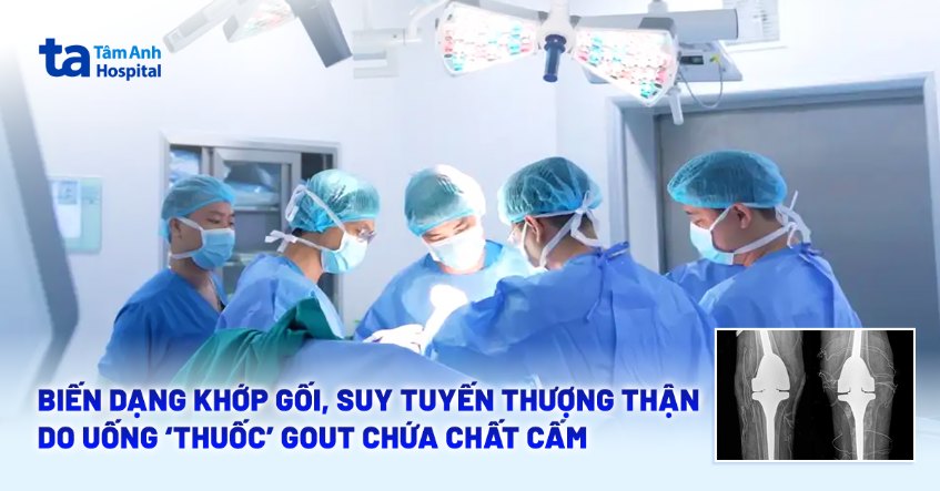 Biến dạng khớp gối, suy tuyến thượng thận do uống ‘thuốc’ gout chứa chất cấm