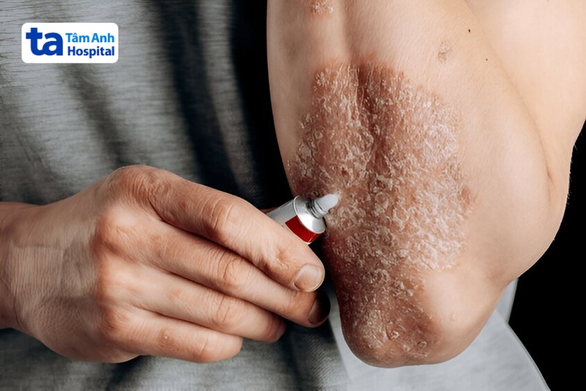 bôi thuốc trị vảy nến giúp giảm viêm và làm dịu da