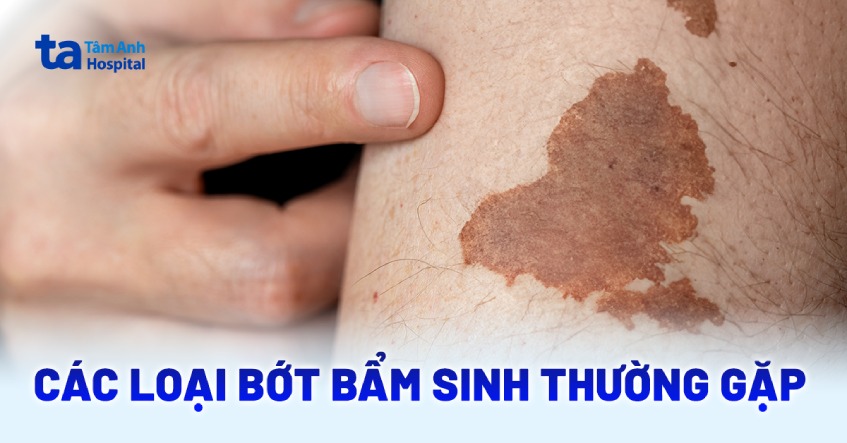 Hiểu thêm về các loại bớt bẩm sinh và cách điều trị