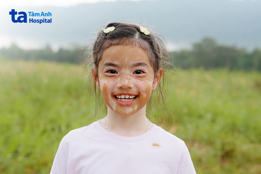 các loại rối loạn sắc tố da bẩm sinh