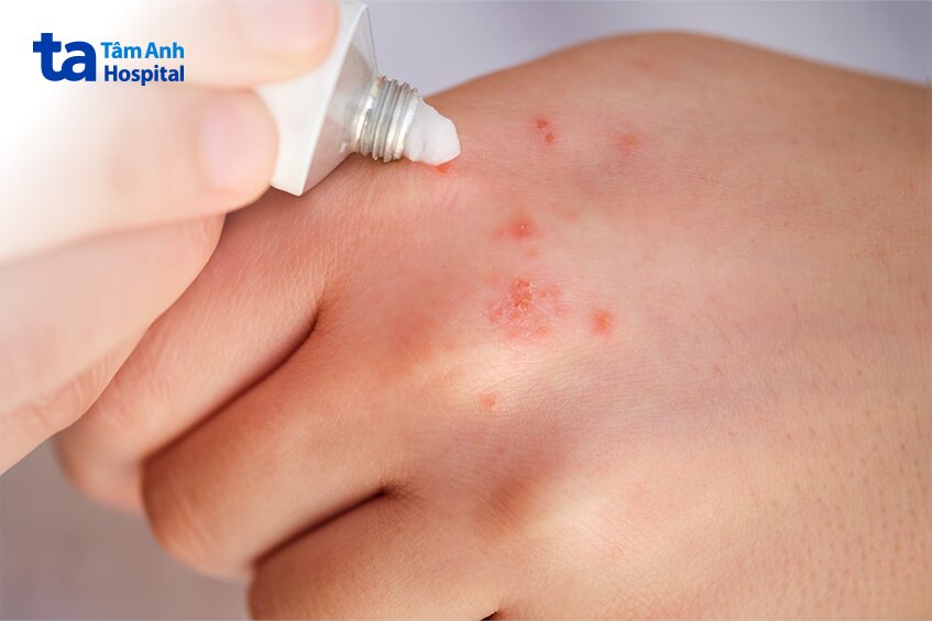 cải thiện bằng thuốc bôi tại chỗ