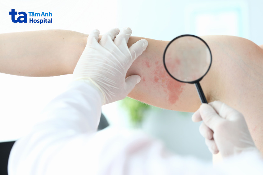 chẩn đoán bớt bẩm sinh