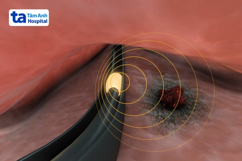 chất phòng xạ được đặt gần trong khối u
