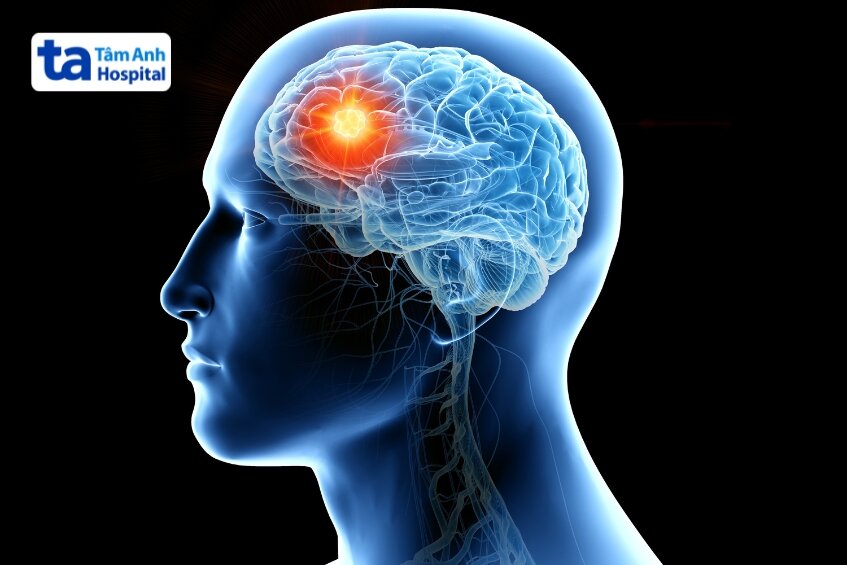 chỉ định thực hiện cho ung thư não đầu cổ