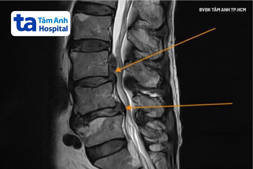 chụp mri phát hiện đốt sống thắt lưng tổn thương
