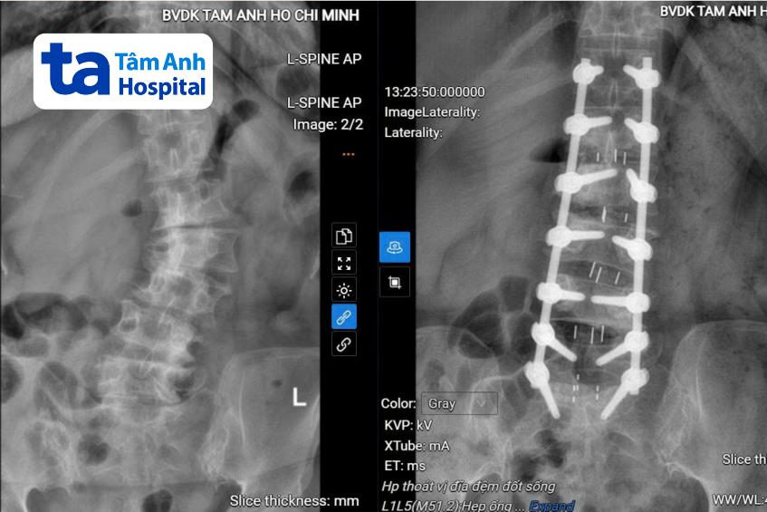 cột sống người bệnh trước và sau khi phẫu thuật