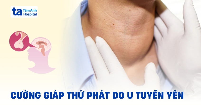 Cường giáp thứ phát do u tuyến yên khắc phục như thế nào?