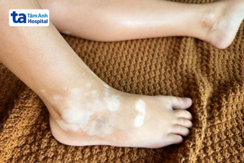 da chân trẻ em bị rối loạn sắc tố