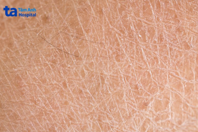 da khô sắc tố bong tróc