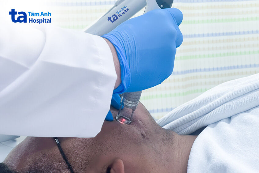đang điều trị sẹo bằng laser cho khách hàng