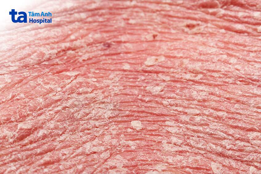 dấu hiệu nhận biết đỏ da toàn thân