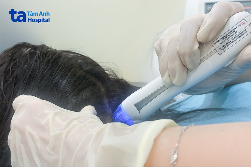 điều trị rụng tóc bằng vi kim rf