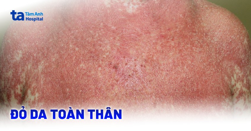 Đỏ da toàn thân nhận diện thế nào? Hướng điều trị