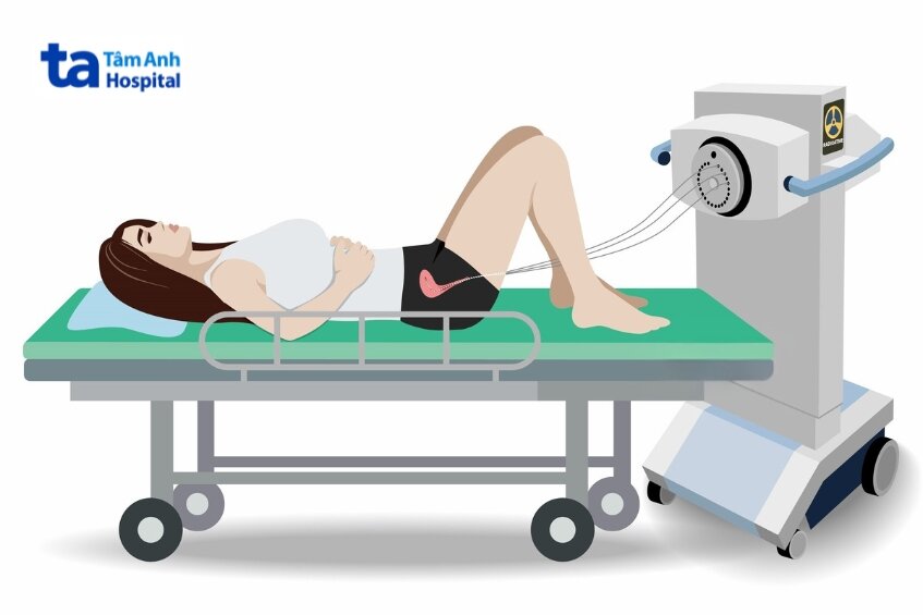 đưa nguồn phóng xạ nhỏ trực tiếp vào khối u