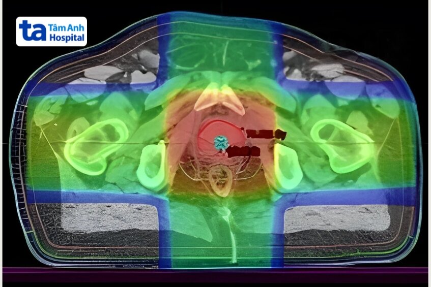 dùng hình ảnh 3d để định vị khối u