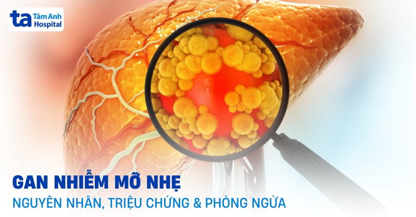 Gan nhiễm mỡ nhẹ là gì? Triệu chứng và phòng ngừa