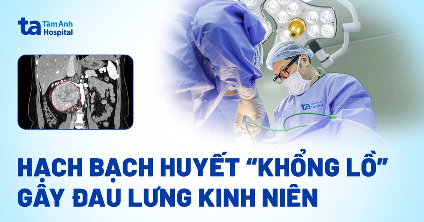 Hạch bạch huyết “khổng lồ” gây đau lưng kinh niên