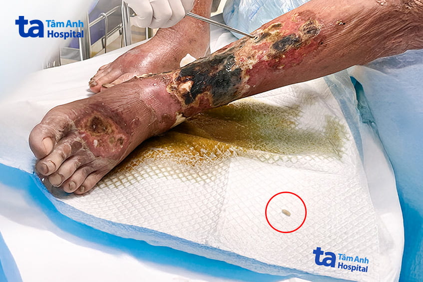 Điều dưỡng khoa Cấp cứu tiến hành xử trí vết thương chân cho ông Nam.