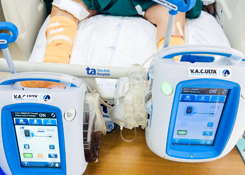 Điều trị VAC liên tục cho người bệnh ở khoa ICU. Ảnh: Bệnh viện Đa khoa Tâm Anh