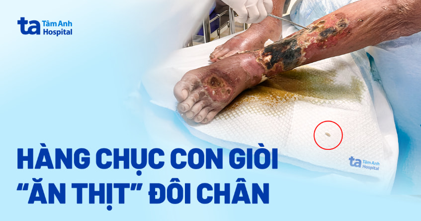 Hàng chục con giòi “ăn thịt” đôi chân