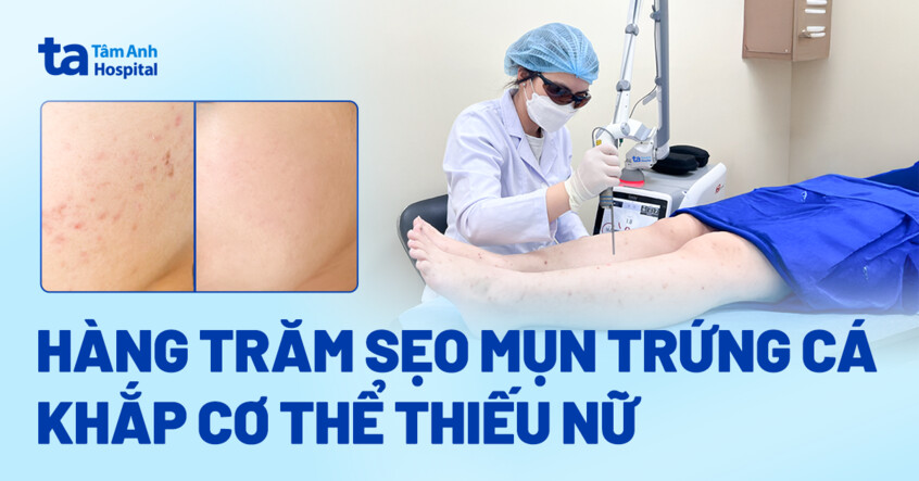 Hàng trăm sẹo mụn trứng cá khắp cơ thể thiếu nữ