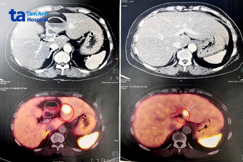 hình ảnh chẩn đoán các khối u gan, tụy