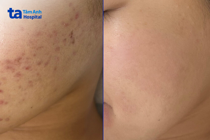 hình ảnh da của bệnh nhân đã được điều trị