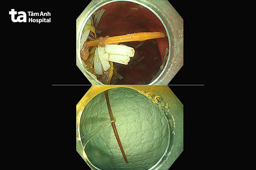 hình ảnh nội soi thấy tăm tre