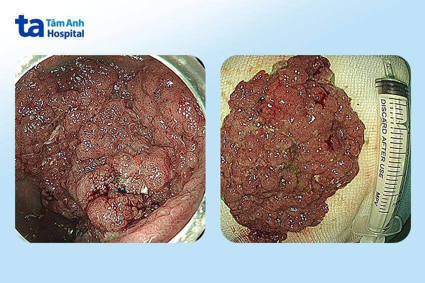 hình ảnh polyp khủng