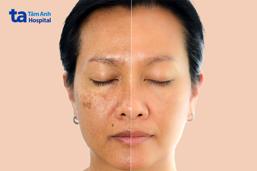 hình ảnh tăng sắc tố da ở mặt