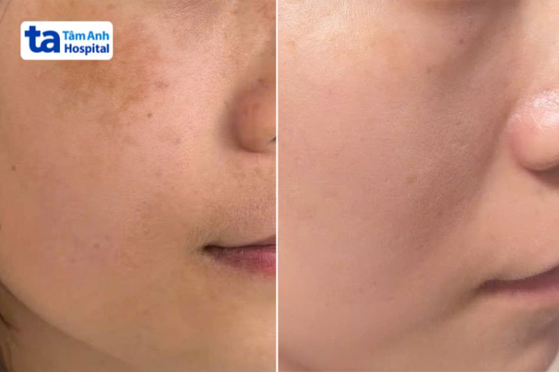 hình ảnh khách hàng trước và sau trị tăng sắc tố
