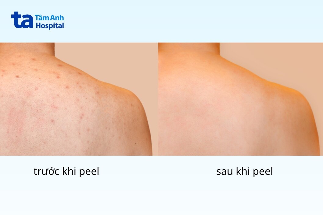 Địa Chỉ Peel Da Uy Tín Tại Tphcm Đảm Bảo Tốt Và Hiệu Quả Hình Ảnh Trước Và Sau Khi Thực Hiện